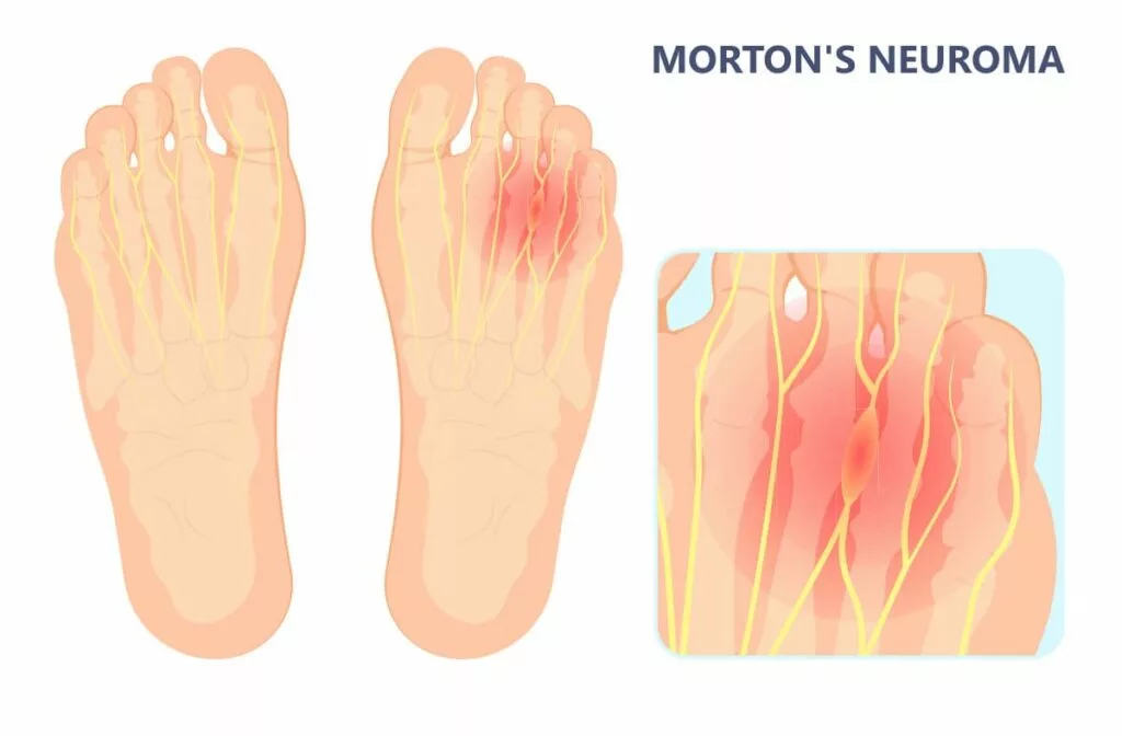 morton neuroma