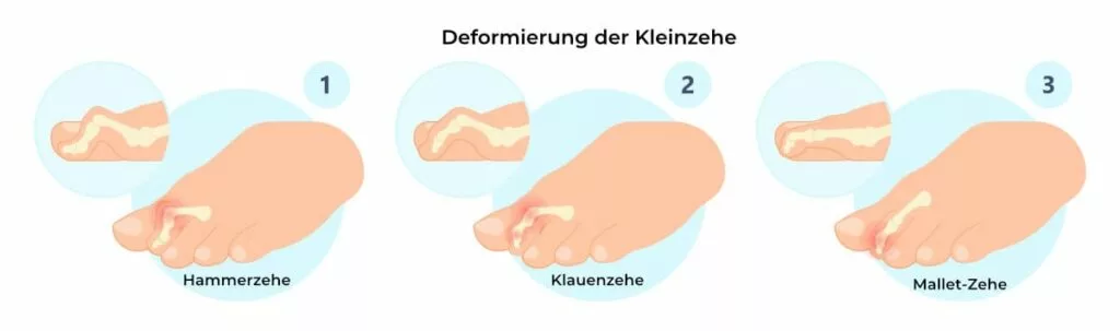 kleinzehfehlstellung